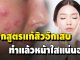 แจกสูตรสิวอักเสบที่เห็นกันแล้วต้องรีบเซฟเก็บไว้ทำตามกันเลย