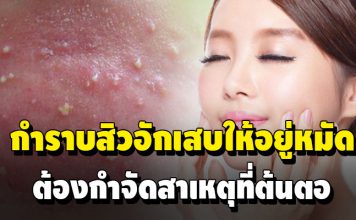 กำราบสิวอักเสบให้อยู่หมัด ต้องกำจัดสาเหตุที่ต้นตอ