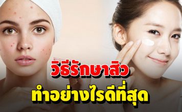 วิธีรักษาสิว ทำอย่างไรดีที่สุด 2020