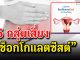 ไขข้อข้องใจ กับ 5 กลุ่มเสี่ยง “ช็อกโกแลตซีสต์”